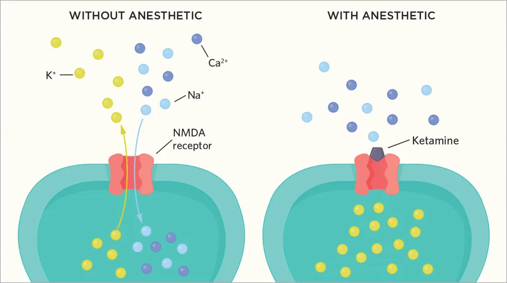 Diagram comparing synaptic activity without anesthetic and with ketamine. Left side shows ions (K+, Ca2+, Na+) interacting with NMDA receptor. Right side, akin to Matthew Perry's journey, shows ketamine blocking the receptor, preventing ion flow. - Ketamine